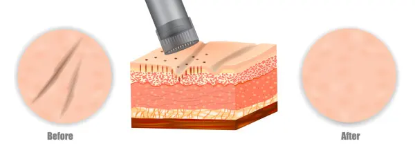 Narbenbehandlung mit Microneedling