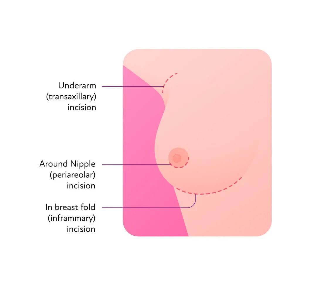 Access for breast surgery - breast augmentation with breast implants - plastic surgery Berlin
