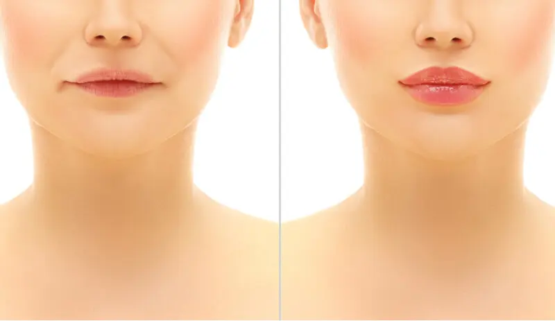 Lippen aufspritzen: Vorher und nachher