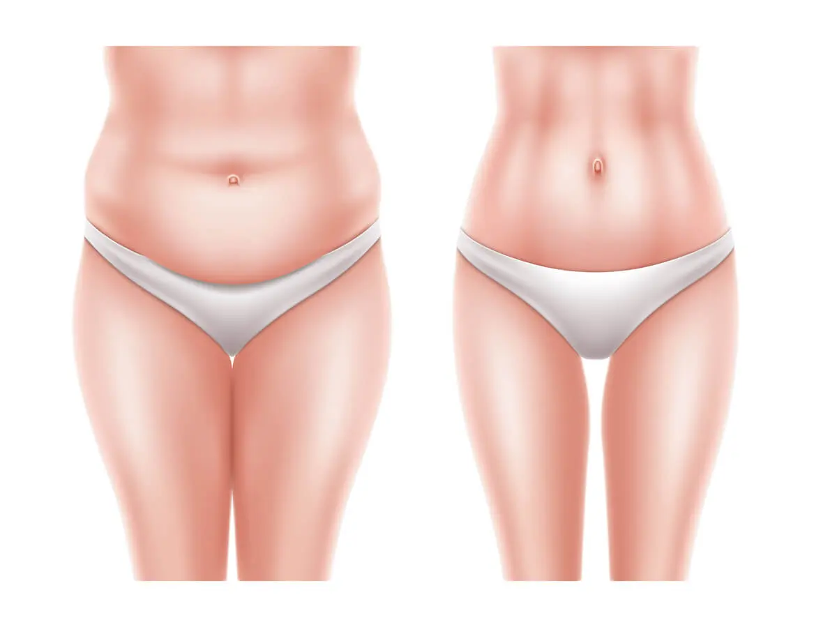 Treatment of abdominal fat pads - Liposuction and Liposuction - Plastic and Aesthetic Surgery Berlin