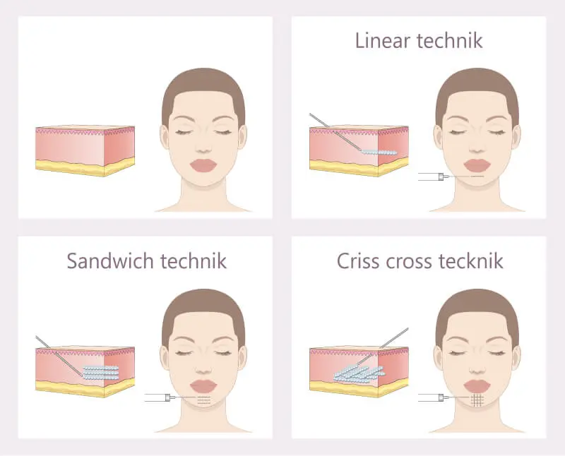 Techniken der Lippenunterspritzung mit Hyaluron