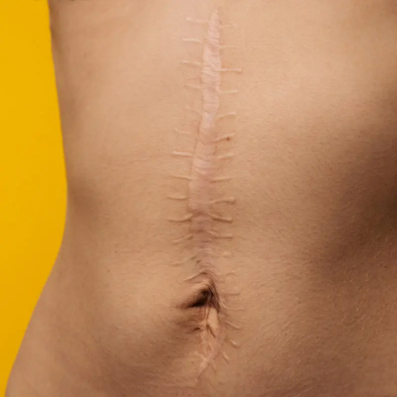 Unschöne Narbe am Bauch