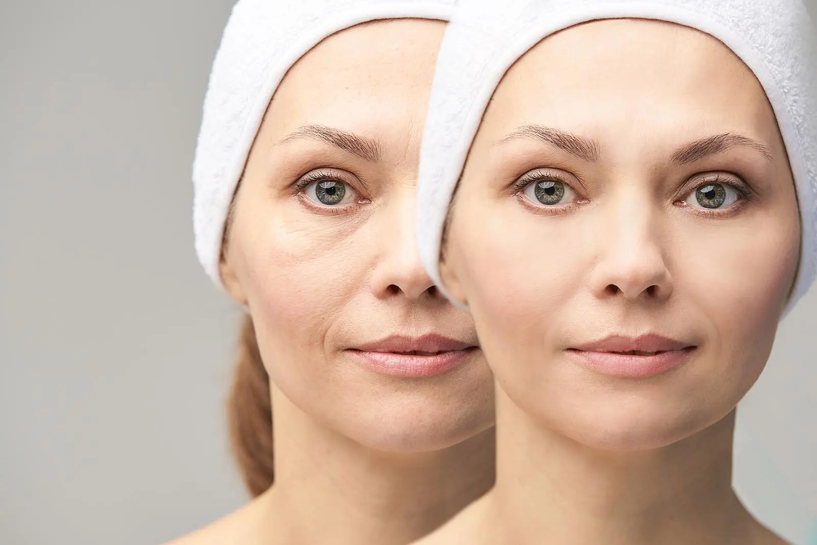 Open gaze and radiant eyes through lower eyelid lift - with one procedure, correction of sagging lower eyelids and eye bags