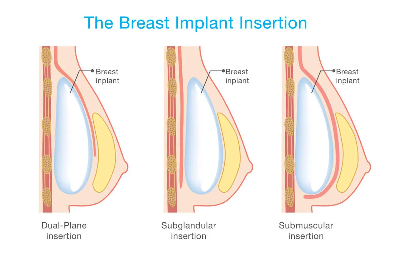 Mammoplasty with implants: above or below the pectoral muscle. Aesthetic surgery and expertise in Berlin