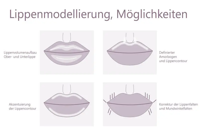 Möglichkeiten der Lippenmodellierung