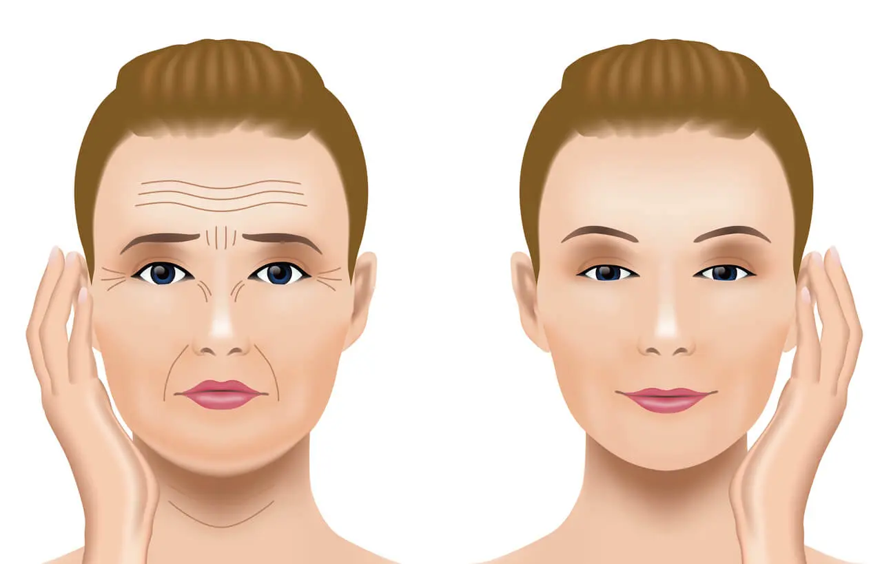 Forehead wrinkles before-after