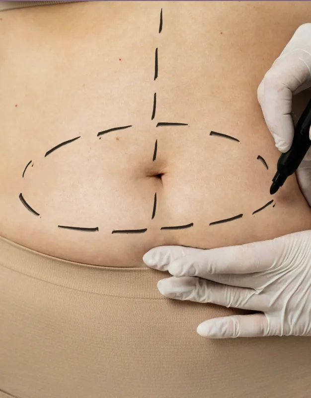 Fettabsaugung Bauch