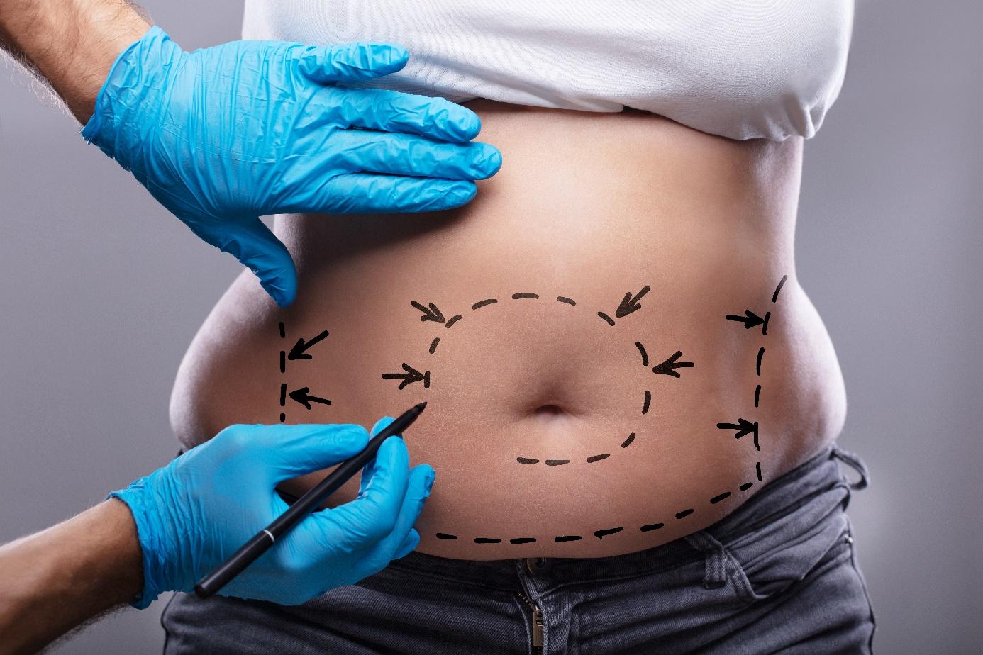 Fettabsaugung Bauch