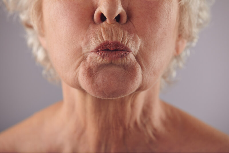 Lip lines