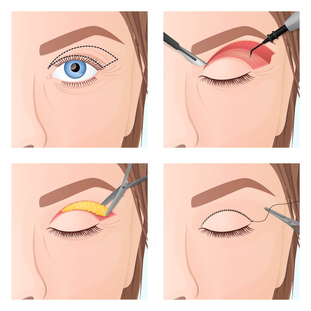Upper eyelid lift with skin resection, incision and blepharoplasty scar – eyelid surgery in Berlin