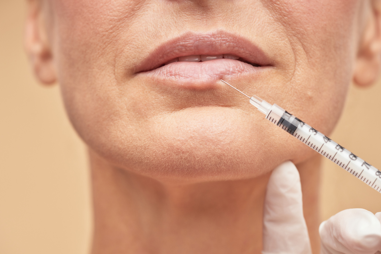 Lip wrinkle removal