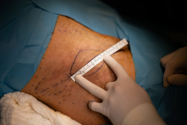 Narbenkorrektur durch Facharzt für plastische und ästhetische Chirurgie