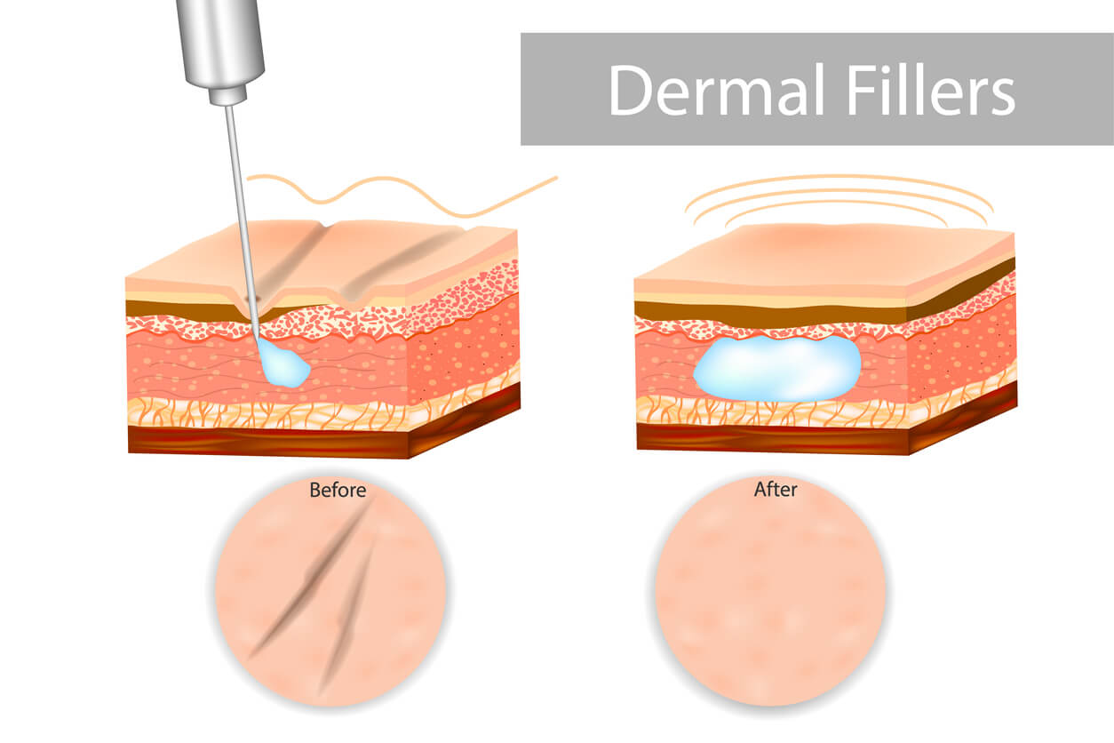 Smoothing wrinkles with hyaluronic acid injections