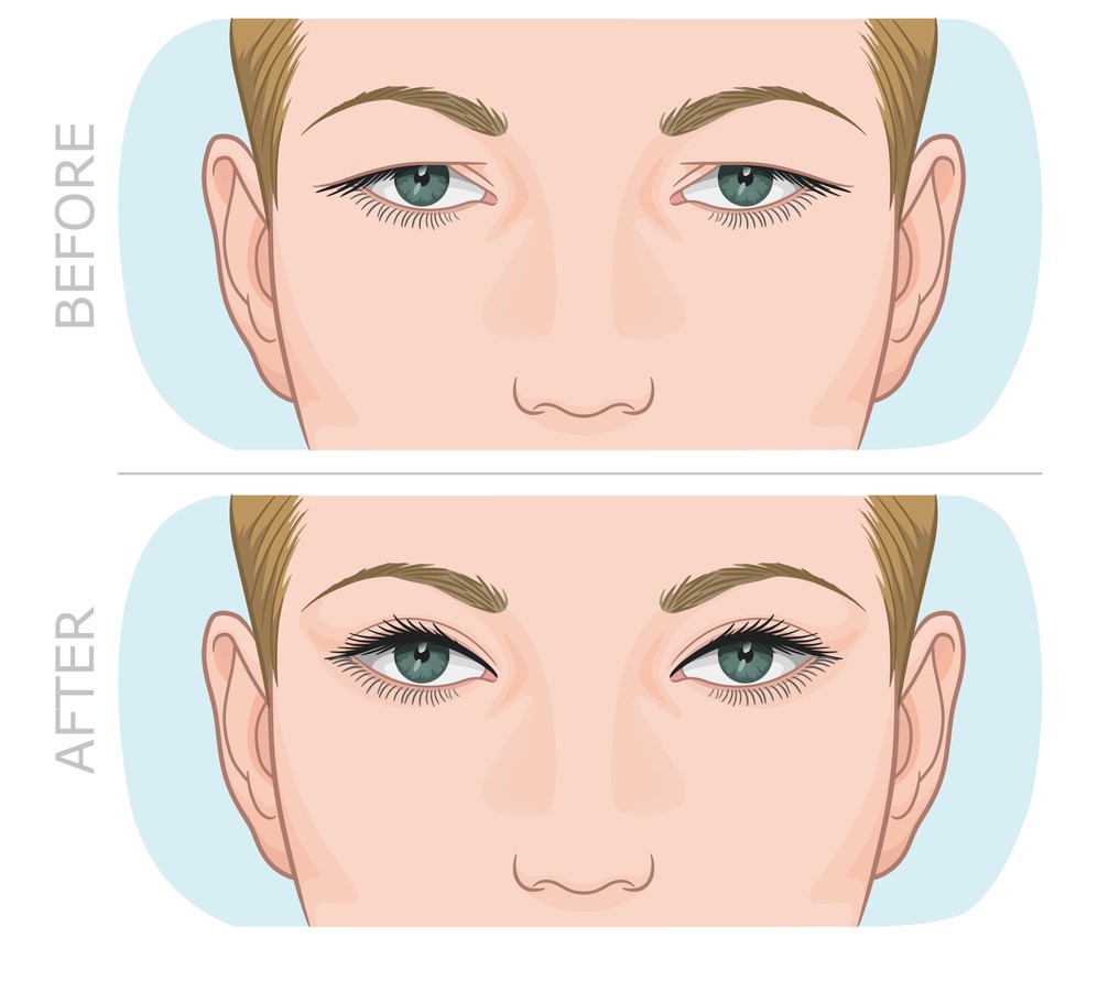 Upper eyelid lift result after removal of excess skin in Berlin plastic and aesthetic surgery