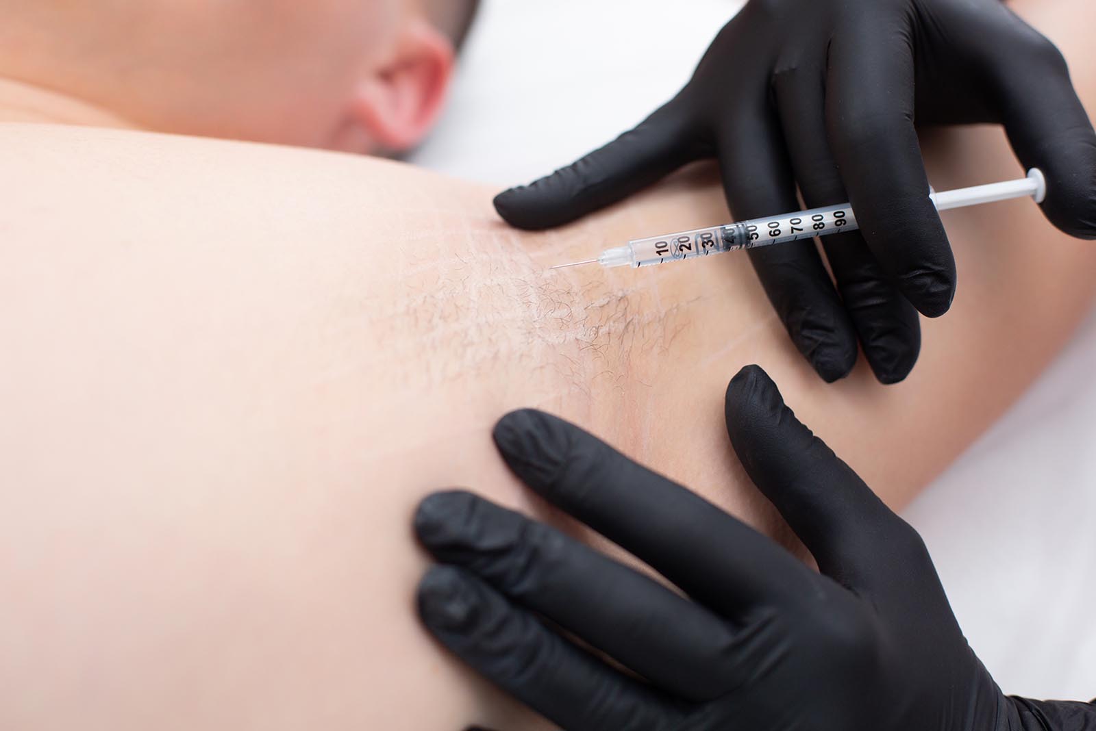 Schweißreduktion durch Botoxbehandlung- Hyperhidrose Spezialisten- Berlin