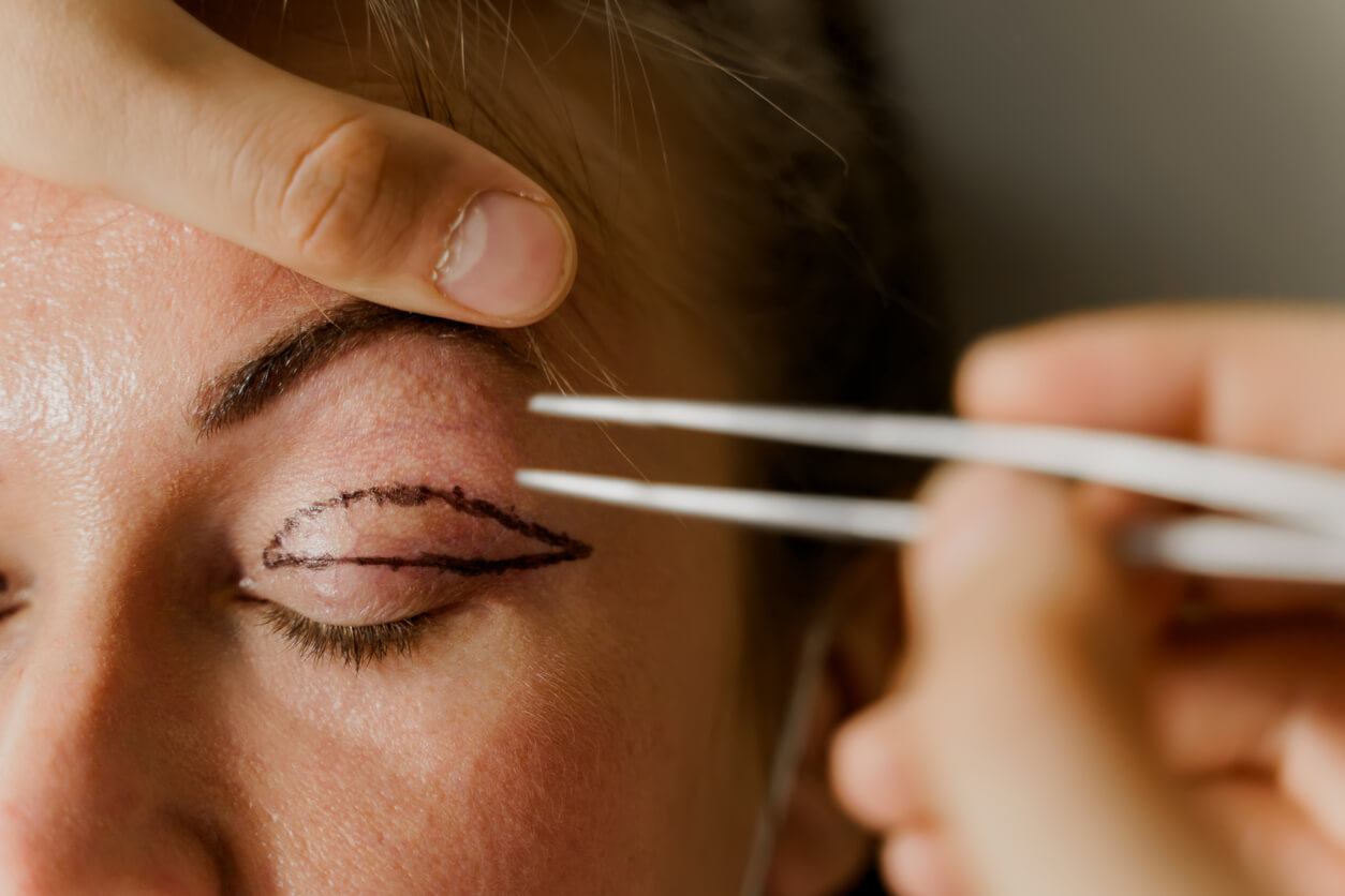 Upper eyelid surgery and upper eyelid lift for hooded eyelids in Berlin