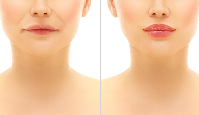 Lip fillers before and after treatment