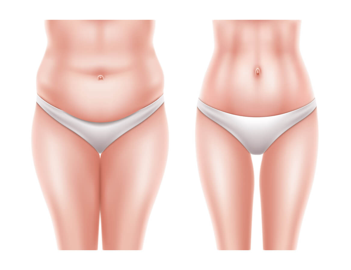 Behandlung Fettpolster am Bauch- Fettabsaugung und Liposuktion- Plastische und ästhetische Chirurgie Berlin