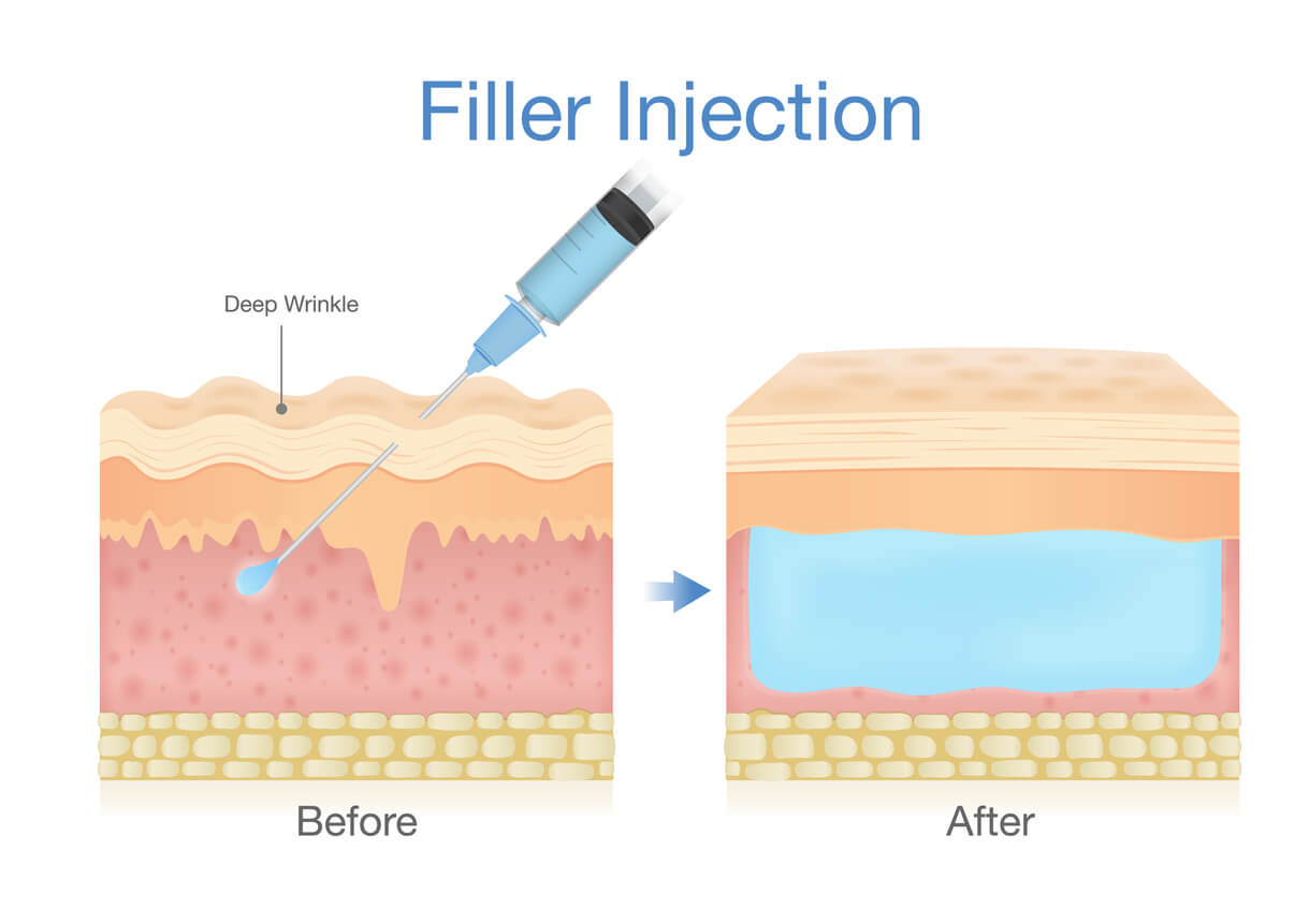Hyaluron-Filler (Injektion)