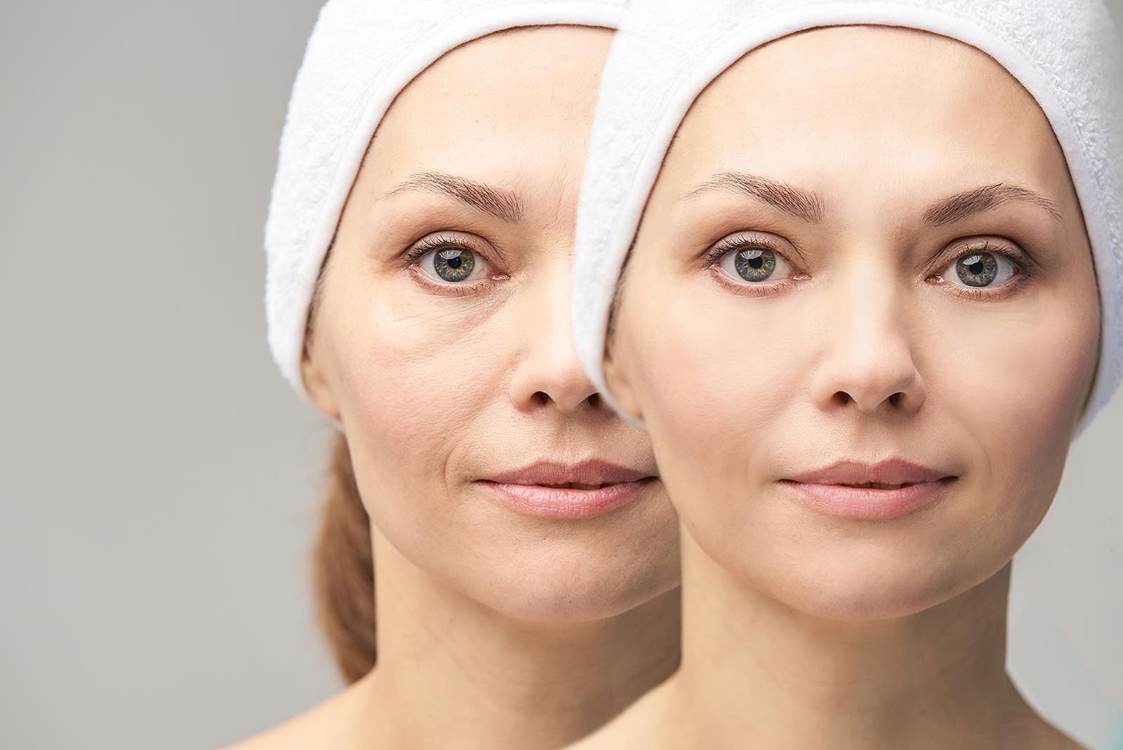 A more open, refreshed eye area after a lower eyelid lift to treat lax lower eyelids and under-eye bags