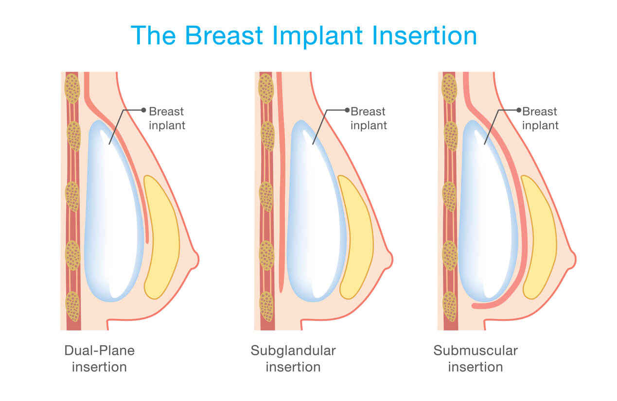 Mammaaugmentation mit Implantate: über dem Brustmuskel oder unter. Ästhetische Chirurgie und Kompetenz in Berlin Charlettnburg