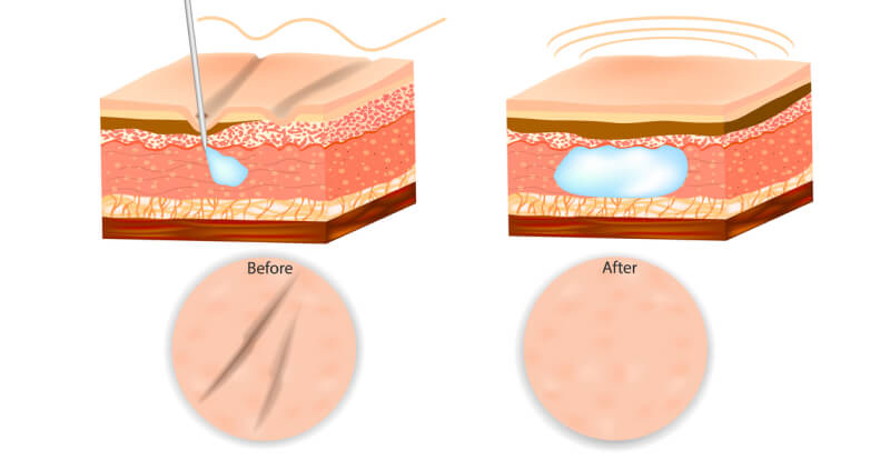 Hyaluronic acid injections for lip wrinkles