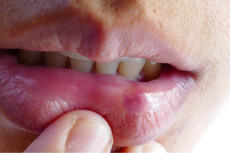 Bruising after lip filler injections